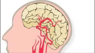 Trombolyse behandeling na een herseninfarct [upl. by Radferd786]