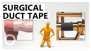 Surgical Duct Tape Animated Explainer [upl. by Anaugahs]