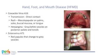 Viral Rashes in Children [upl. by Yemane]