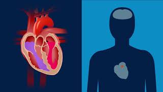 Was ist Vorhofflimmern  Erklärfilm  Medtronic [upl. by Nahgiem]