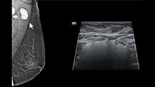 Impregnação de linfonodos axilares por silicone Achados da mamografia e da ultrassonografia [upl. by Malorie]