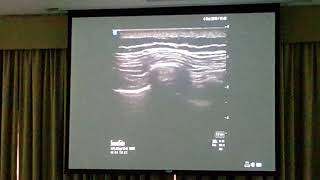 NYSORA Dubai 2019 USG Erector Spinae Plane ESP Block [upl. by Bussy]