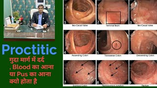 Proctitis Pain in Rectum Chrons Disease  ulcerative Colitis Dr Sanjeet Sahu [upl. by Arym260]