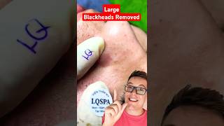 CRAZY BLACKHEAD REMOVAL  Huge Blackheads On Nose shorts [upl. by Lewiss]