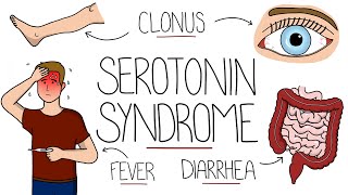 Serotonin Syndrome Explained Serotonin Toxicity [upl. by Yleme]