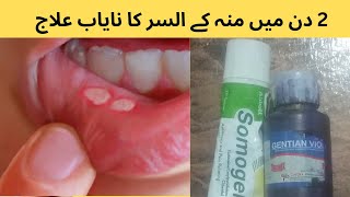 Quick Relief Home Remedies to Cure Mouth Ulcers Fast [upl. by Amsirak]