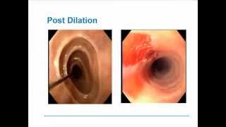 Eosinophilic Esophagitis [upl. by Orola]