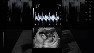 This is What a Babys Heartbeat Sounds Like During an Ultrasound science natal shorts [upl. by Alyaj473]