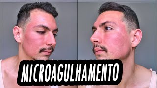 RECUPERAÇÃO APÓS MICROAGULHAMENTO ANTES E DEPOIS HomensqueseCuidam [upl. by Refiffej318]