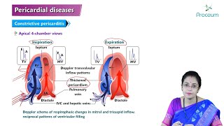 Pericardial Disease Hindi  Etiology Clinical Features Diagnosis Treatment and Complications [upl. by Vinaya]