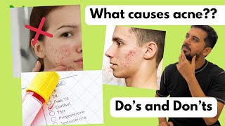 What causes Acne Do’s and Don’ts [upl. by Gniw]