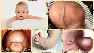 10 COMMON BIRTH DEFECTS  GENETIC DEFECTS IN PREGNANCY  WHAT ARE BIRTH DEFECTS [upl. by Haidebez554]