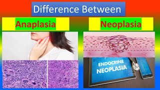 Difference between Anaplasia and Neoplasia [upl. by Hsejar]