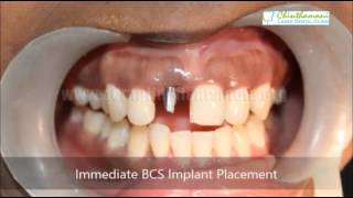 Gum Treatment Chennai  Periodontal Treatment Tamilnadu  Flap Surgery India [upl. by Aifoz]