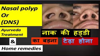 Naak Ki Haddi Ka Badna  आयुर्वेद इलाज  Symptoms amp Medicines  naak ki haddi badhne se kya hota hai [upl. by Odraner482]