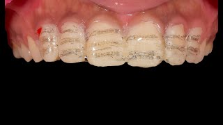 Step by Step Veneer Preparation And Cementation  EMAX Porcelain Veneer  Clinical case [upl. by Blackwell553]