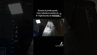 Ultrassom de uma gravidez gemelar Ultrasound of a twin pregnancy [upl. by Schrader]