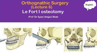 Le Fort I osteotomy  Orthognathic Surgery  Oral amp Maxillofacial Surgery  Syed Amjad Shah [upl. by Shay]