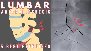 Best Exercises for Lumbar Anterolisthesis  Relieve Lower Back Pain  Dr Jon Saunders [upl. by Wald]