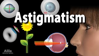 Astigmatism Types Causes Symptoms and Treatment Options Animation [upl. by Berky991]