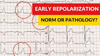 Early repolarization syndrome and pattern Norm or pathology [upl. by Binni]