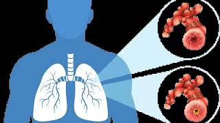 Common Symptoms of Epithelioid Mesothelioma [upl. by Garold530]