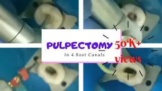 pulpectomy PULPECTOMY STEP BY STEPKEDO SG BLUE FILESINGLE SITTING PULPECTOMY IN 4ROOT CANALS [upl. by Ammann]