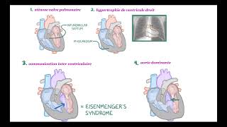 cardiopathies congénitales cyanogènes [upl. by Elehcim]