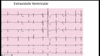 Extrasistole Ventricular EKG [upl. by Audi]