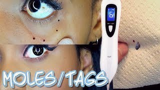 MOLES amp SKIN TAGS FALL OFF WITH AT HOME DARK SPOT REMOVAL PEN [upl. by Enovad207]