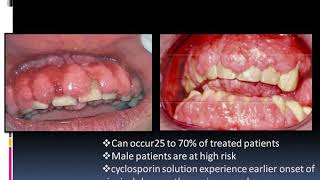 Drug Induced Gingival Enlargement [upl. by Marx]