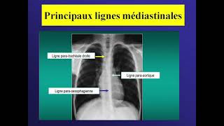 Lecture d’une radiographie thoracique Pathologique Sd Parenchymateux et médiastinal 22 [upl. by Enyluqcaj]