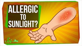 Can You Be Allergic To Sunlight [upl. by Simmie741]