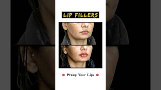 The Secret to Fuller Lips  Sarayu Clinics lipfiller [upl. by Lucinda]