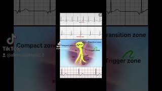 Junctional Rhythms made easy [upl. by Bianka]