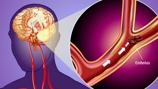 Stroke Prevention amp Transient Ischemic Attack TIA [upl. by Irme]