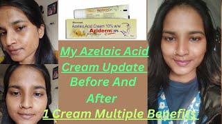 My Azelaic Acid Cream 10 Update  Before And After  Azidem Cream  1 Cream Multiple Benefits [upl. by Jansen]