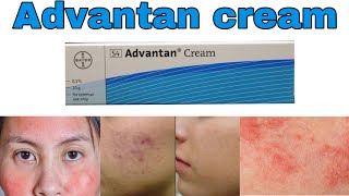 Advantan cream uses and benefits methylprednisolone side effects How to use for skin infections [upl. by Kciredohr965]