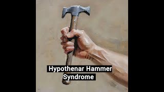 Hypothenar Hammer Syndrome [upl. by Animaj]