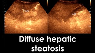 Fatty Liver  Diffuse hepatic steatosis  Liver Ultrasonogram [upl. by Legin719]