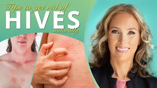 Hives  How to Get Rid of Hives Naturally  Dr J9 Live [upl. by Babs]