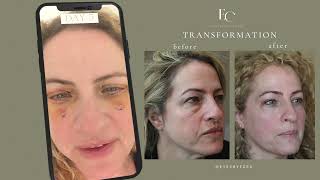 Video Diary of Recovery Process from Blepharoplasty Surgery Day by Day [upl. by Gildus]