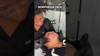 MORPHEUS8 RF MICRONEEDLING 👏 Watch shinebyshintia perform RF Microneedling to help tighten lift a [upl. by Esten712]