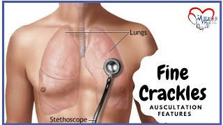 Fine Crackles  Lung Sounds  Auscultation Features [upl. by Gilboa229]