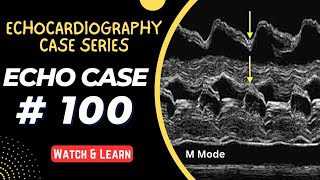 ECHO CASE 100  Echocardiography for Beginners  M Mode Echocardiogram [upl. by Buford]