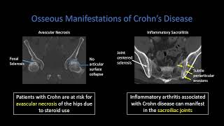 Crohn Disease Part 3 Extraintestinal Findings [upl. by Nauqes]