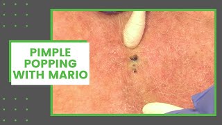 Pimple Popping with Mario  Dr Derm [upl. by Gargan]