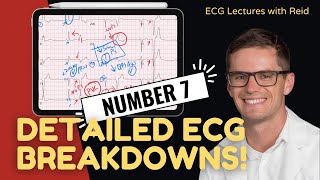 EKG Test Yourself  ECG Case Study 7 [upl. by Amatruda]