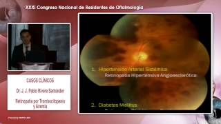 Retinopatía por Trombocitopenia  Dr J J Pablo Rivera  14022015 [upl. by Adamsen]