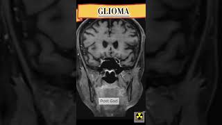 MRI Brain  GLIOMA mriscan medicalimaging See description [upl. by Bart]